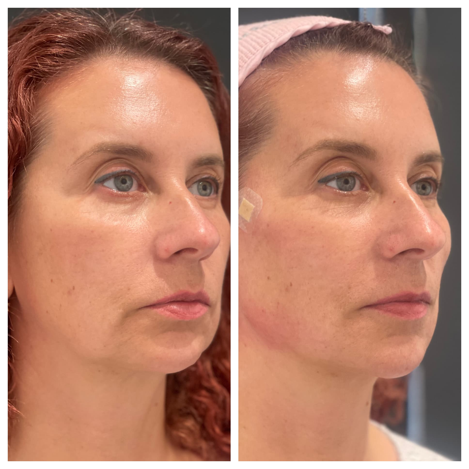 Lifting Threads treatment