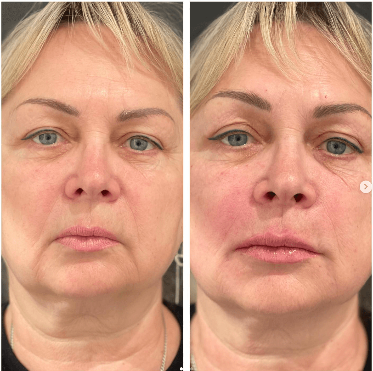 Lip filler treatment