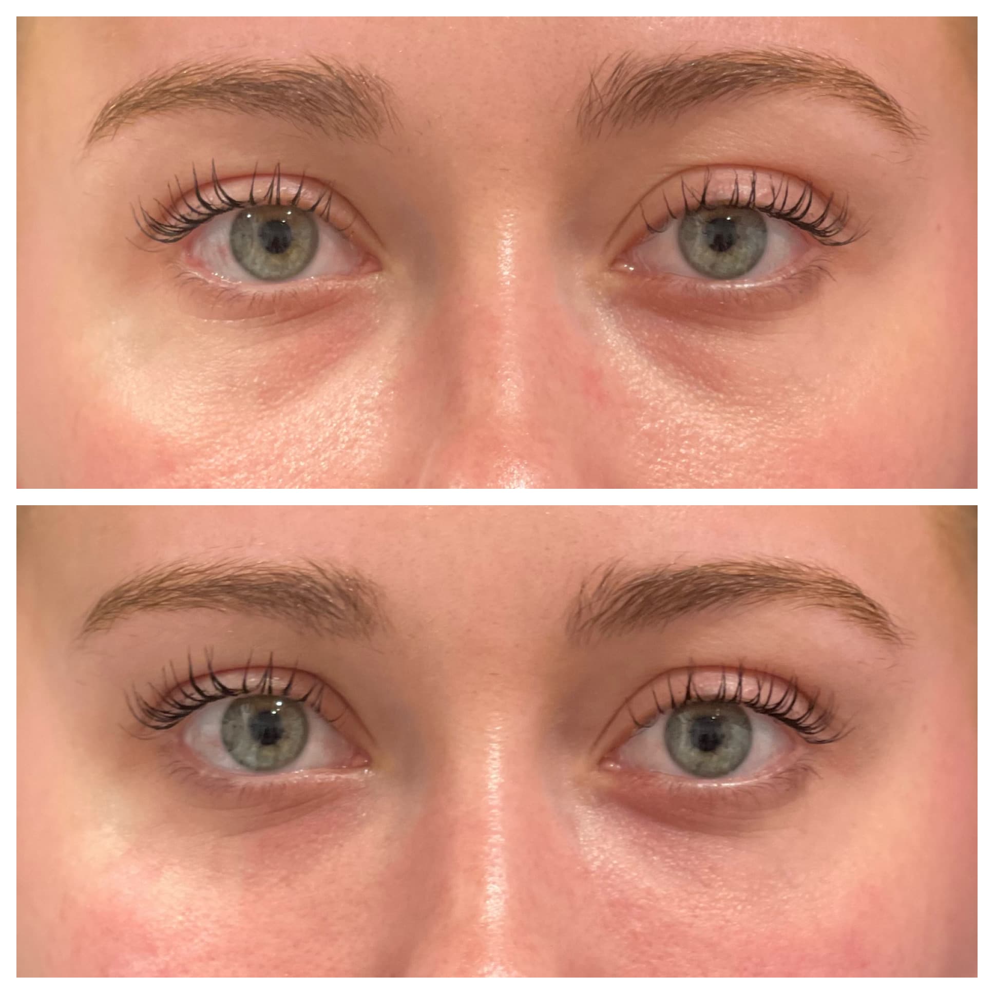 Under Eye filler treatment