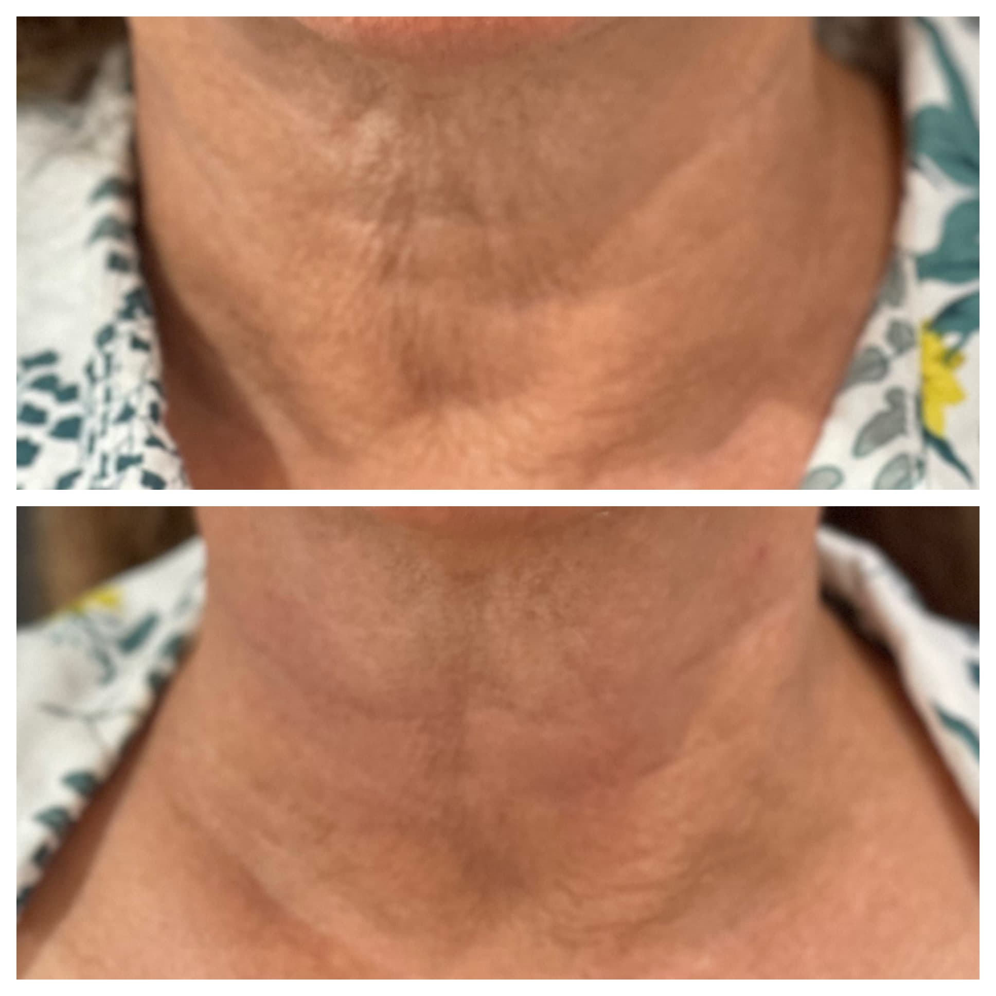 Neck filler treatment