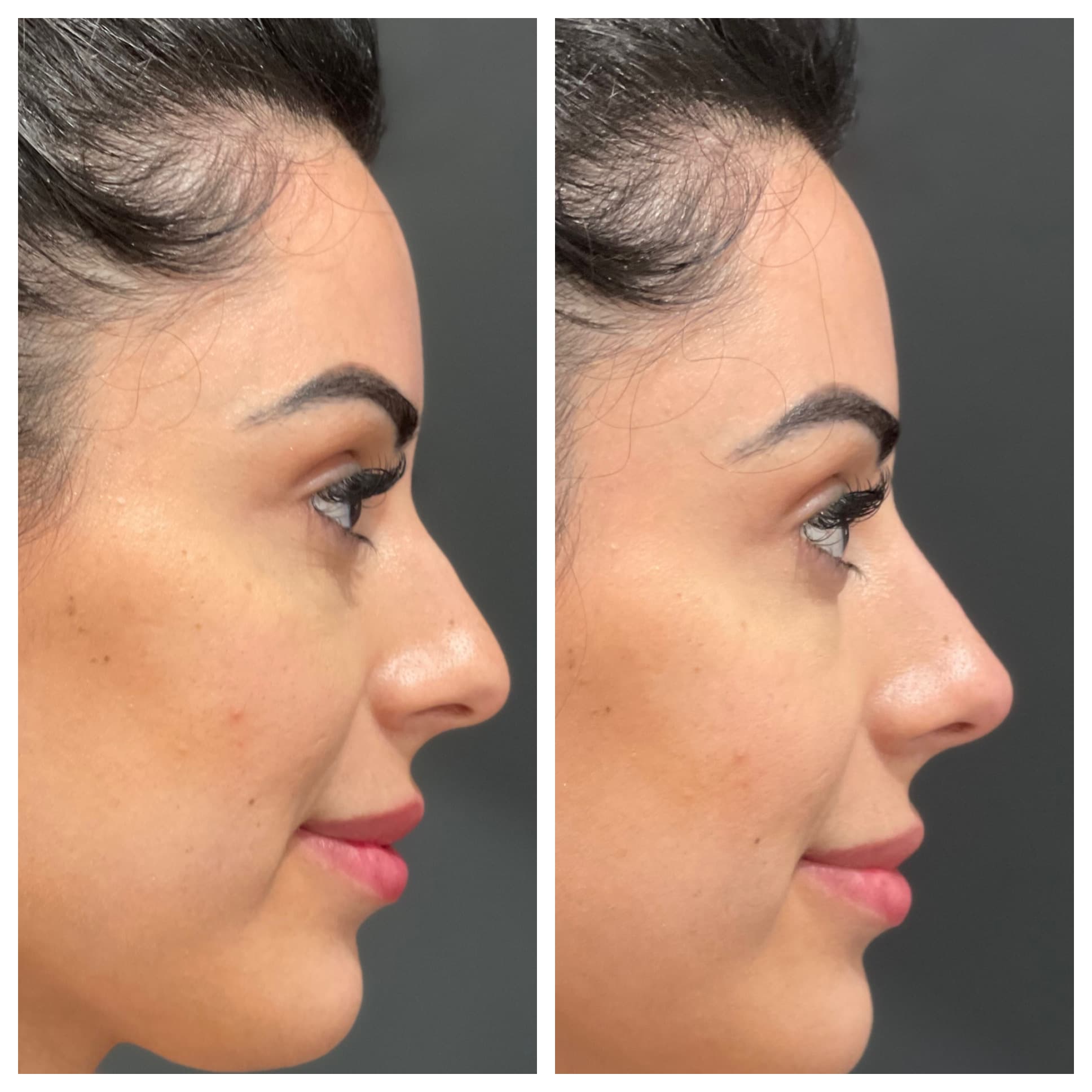 Nose filler treatment