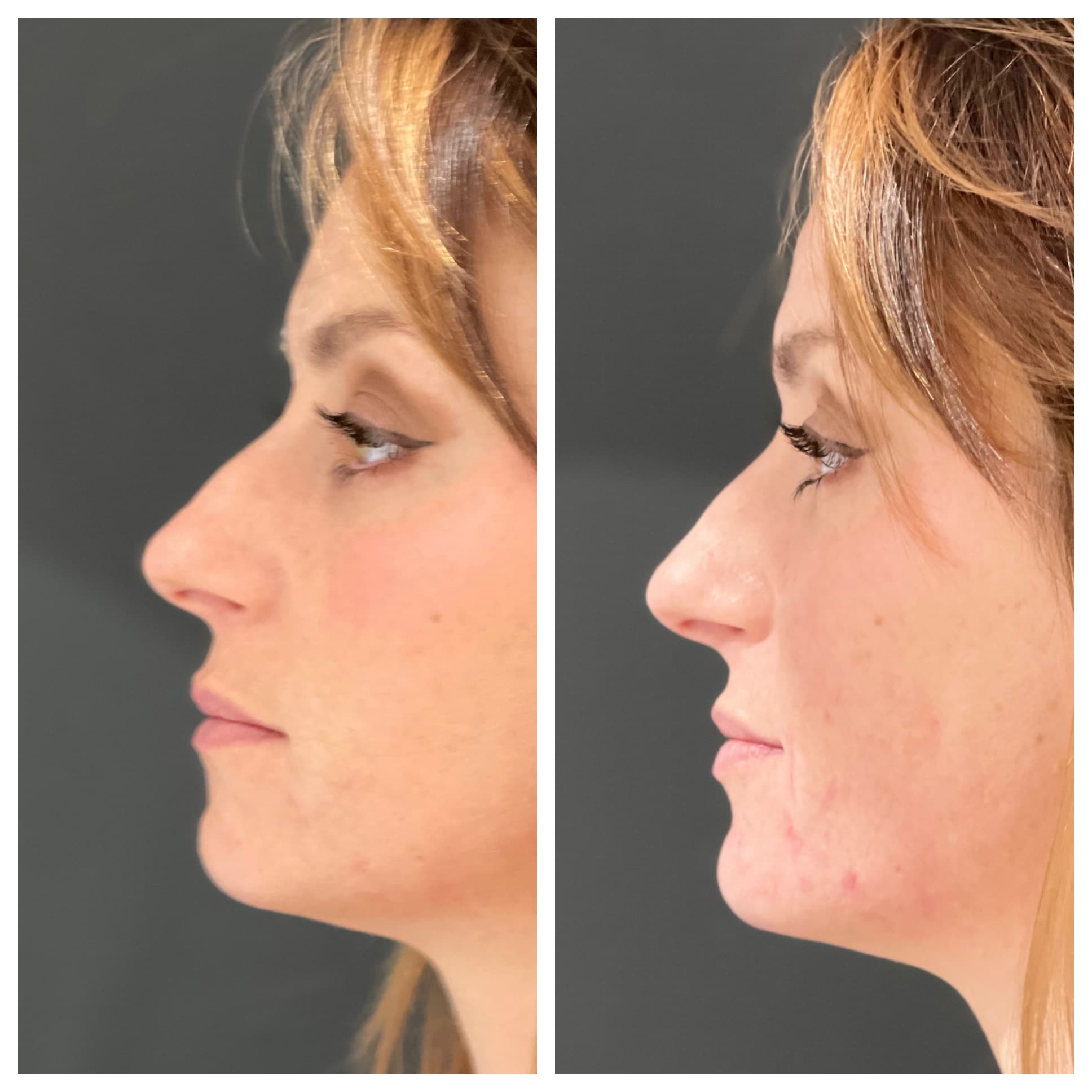 Chin filler treatment